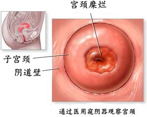 宝鸡宫颈糜烂微创手术