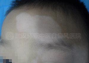 科学系统治疗，10岁男童重获快乐童年